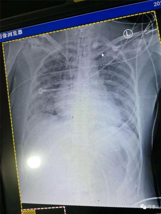 撤机之前的检查发现，李云的肺部纹理开始出现，肺功能在其休息了18天后开始慢慢恢复。