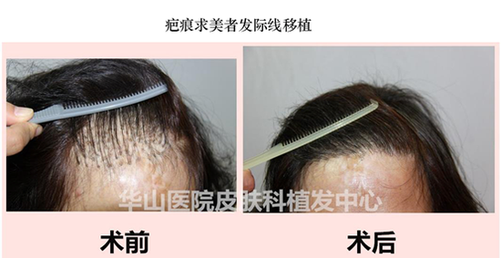 杨幂靠植发赢回了发际线?这些防脱、治脱方法