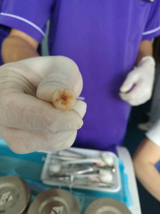 欧贝迎来首位患者体验笑气拔牙 让无痛拔除智齿成为可能