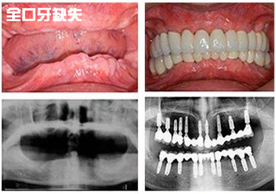 全口牙缺失