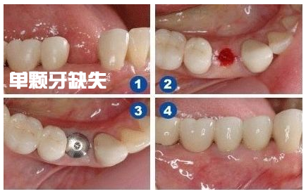 单颗牙缺失