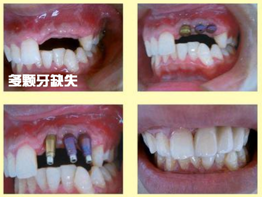 多颗牙缺失