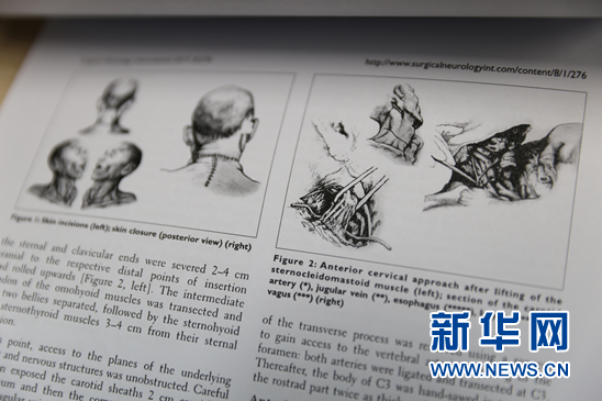 图为,任晓平提供的人体第一个头移植外科手术设计方案局部图。新华网才萌 摄