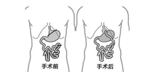 减肥手术是什么原理是什么_减肥黑油便是什么样子(2)