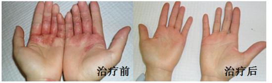 扁康韩医院过敏性皮炎治疗实例