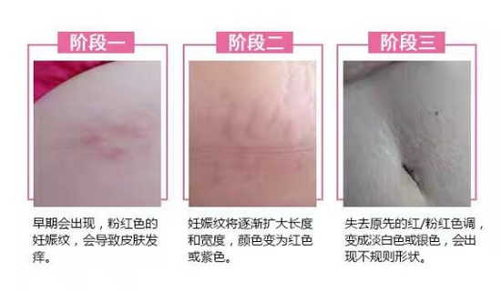 产后三年妊娠纹怎么去除 擦亮眼睛小心被骗