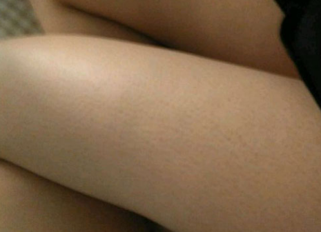 使用康御肤去掉鸡皮肤的现状