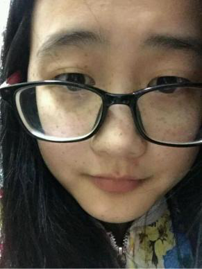 满脸的斑,雀斑的困扰有谁会懂呢