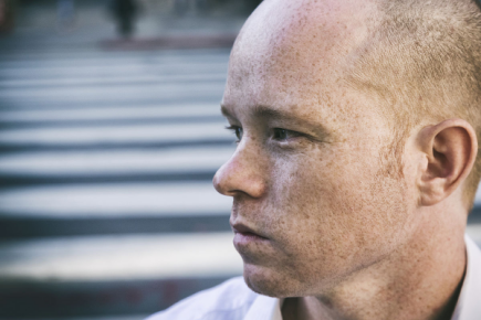 男生脸上雀斑去除方法?揭秘男士去雀斑好的办法