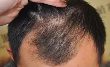 额头头发越来越少,那么额头两侧脱发怎么办