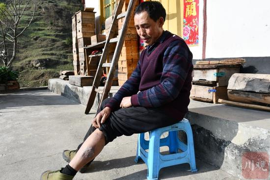 黎青明小腿上去年被黑熊咬伤的痕迹依然可辨。