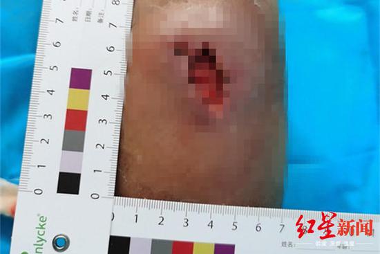 　↑伤口红肿范围约6cm×7cm