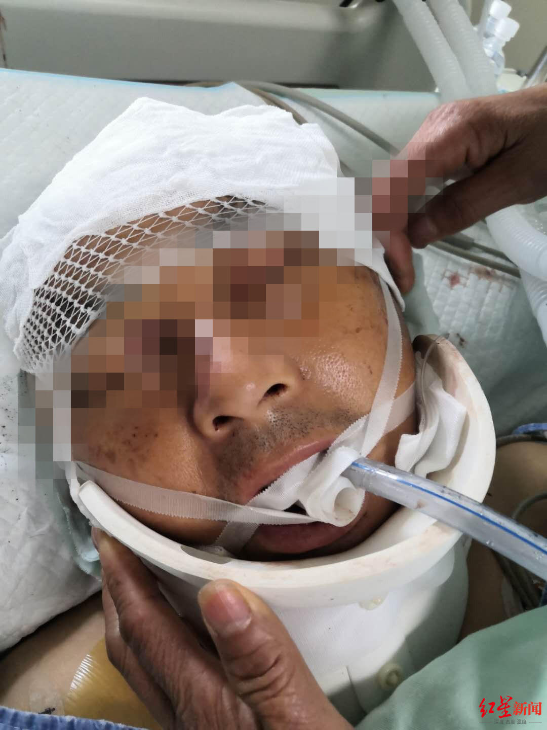 肖光权接受治疗时的照片