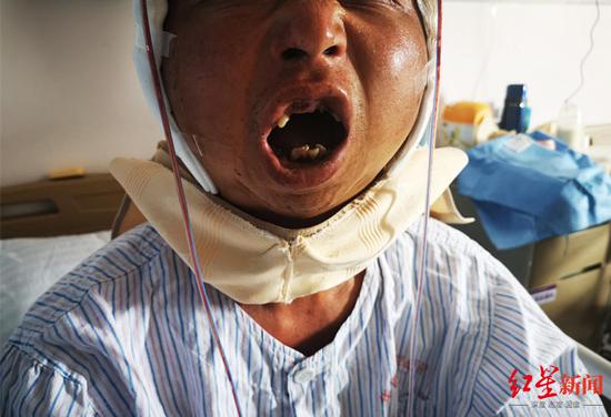 ↑崔先生手術后終于可以張嘴