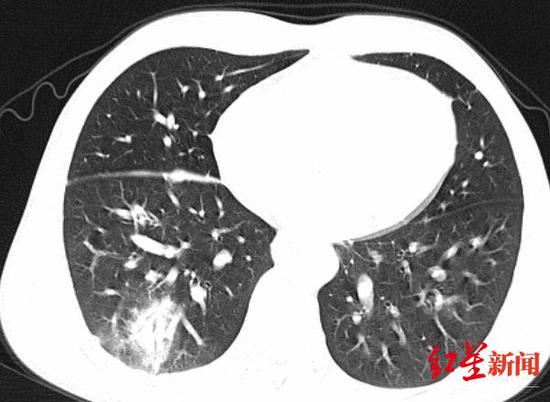 　↑入院时第一次CT检查报告：右肺下叶斑片影及磨玻璃影，部分实变，多系炎性