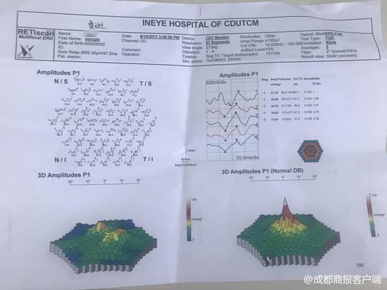 ▲左图为被激光笔灼伤后的视网膜黄斑区,已没有明显峰值。右图为正常的视网膜黄斑区,有明显峰值