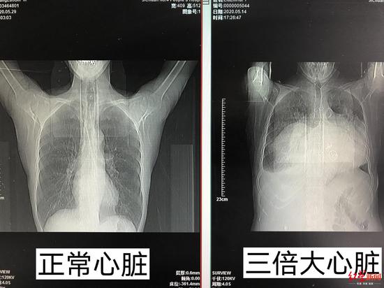 正常心脏大小与张婆婆心脏大小对比图