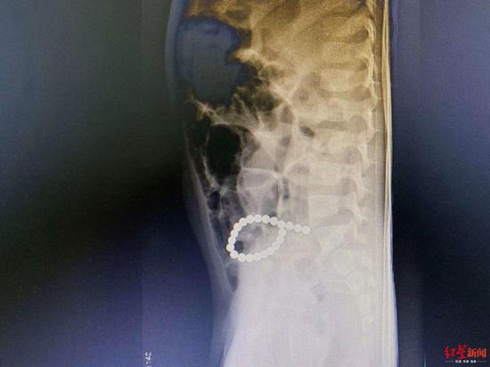 ↑3岁男童腹痛，X光片显示有异物