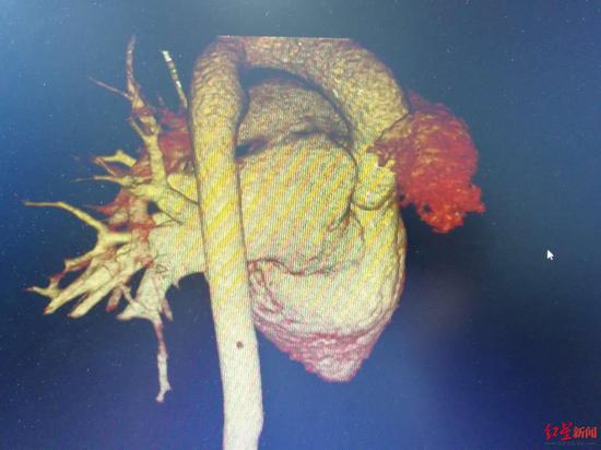 小宇心脏的三位重建图