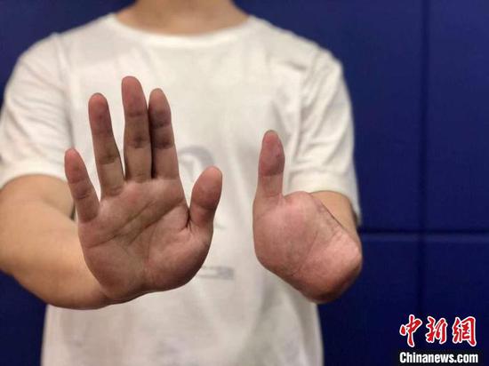 小伙拒絕參與電詐被剁4根手指 沙市警方 供圖