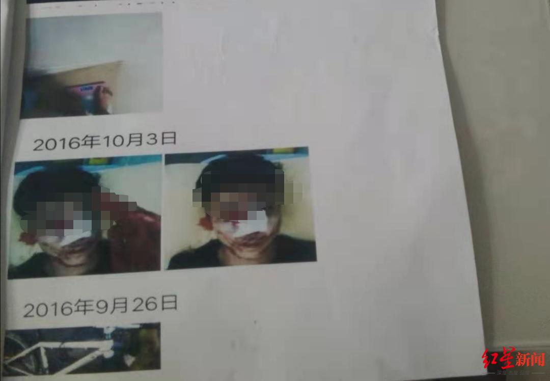 李某某2016年打工時受傷的照片