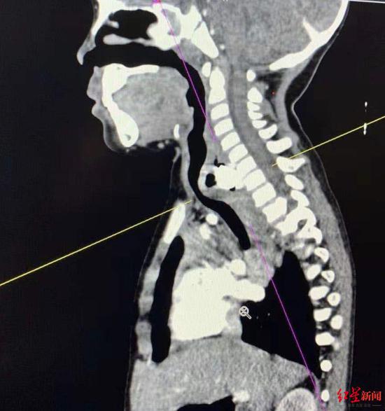 CT检查结果显示颈根部有异物