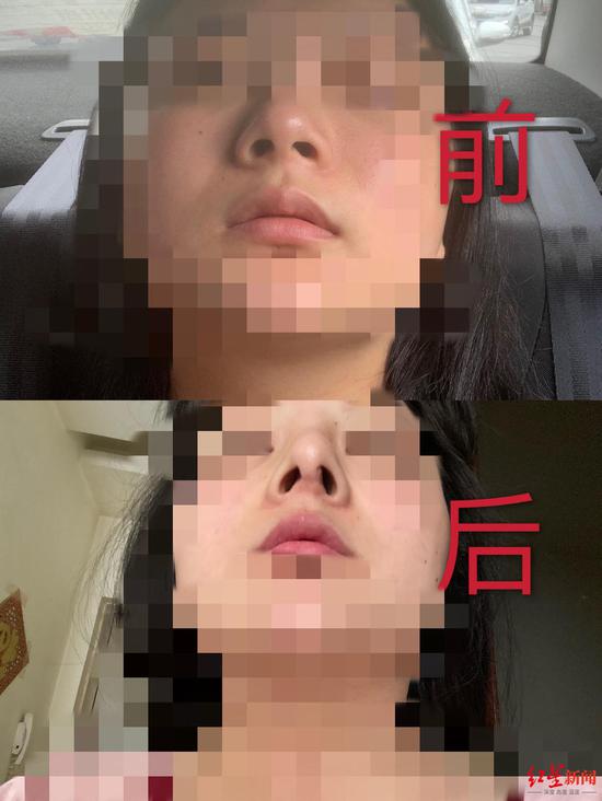 多名消费者术后鼻子歪斜