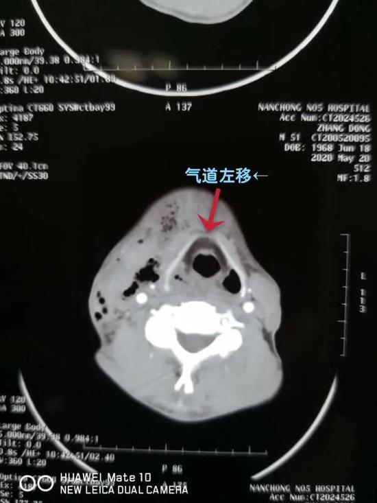 喉腔梗阻致气道偏移