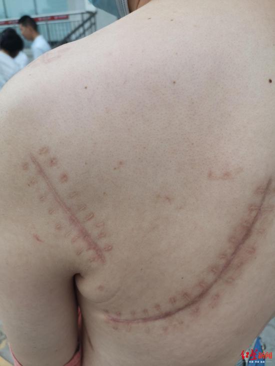 ↑钟科展示身上的伤疤。