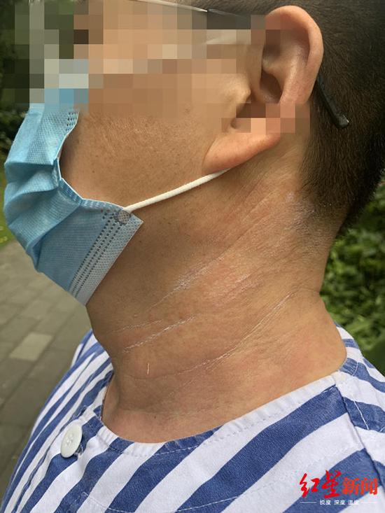 ↑刘先生称,上次理疗右膝盖过敏治疗后,最近身上又有过敏的迹象
