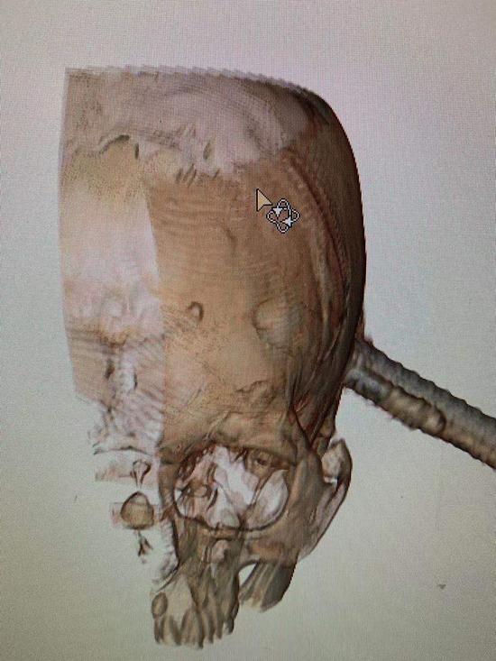 一根直径1.87厘米的钢筋刺入男子头部，刺入长度约为6.83厘米。简阳人医供图。