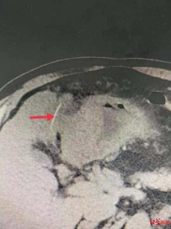 ▲增强CT提示线状异物。