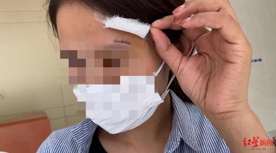 ↑婷婷額頭撞破