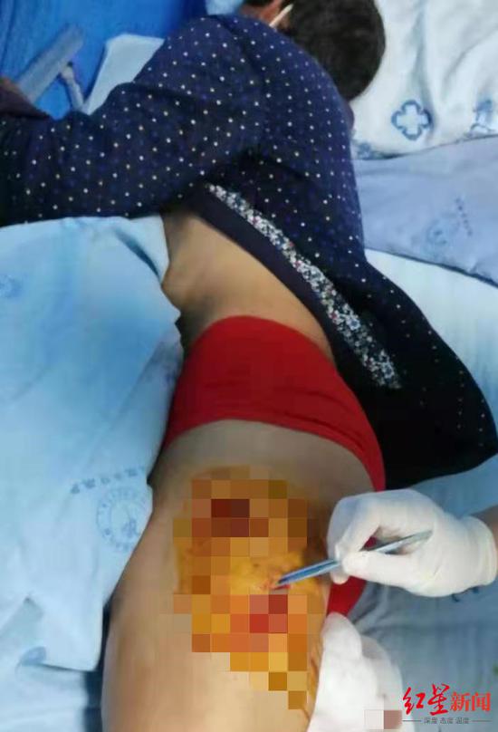 ↑徐幫云大腿被黑熊咬傷。