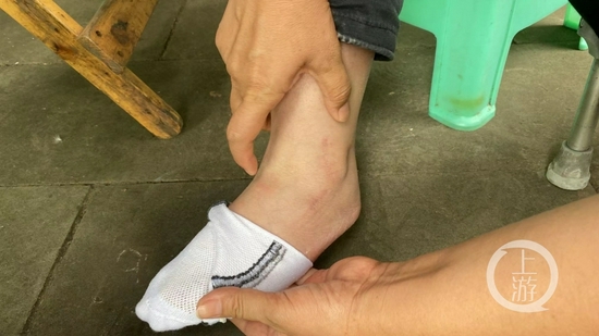 ▲李雪脚关节受伤后，手术后留下的伤疤。摄影/上游新闻记者 胡磊