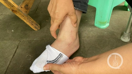 ▲李雪腳關節受傷后,手術后留下的傷疤。攝影/上游新聞記者 胡磊