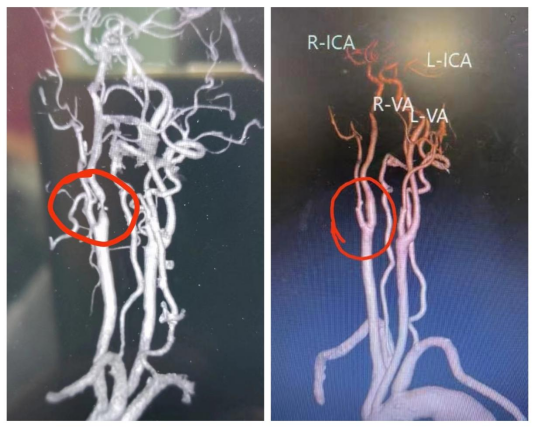 （术前、术后CTA影像对比）