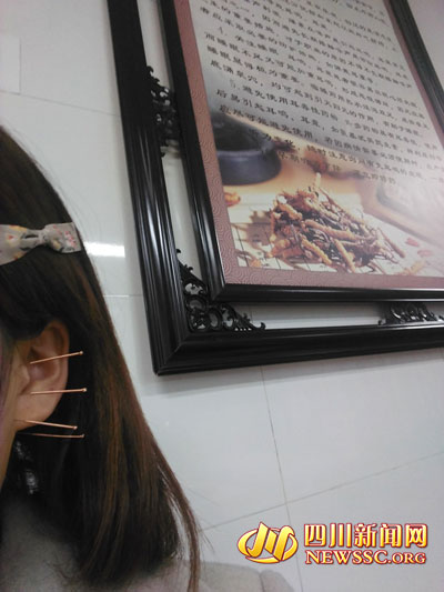 针灸治疗耳部