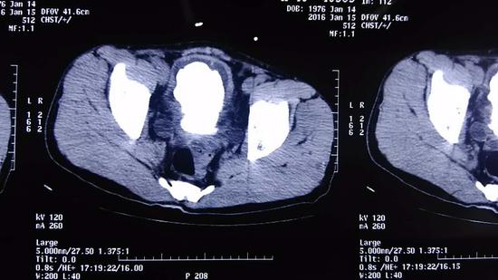 男子 膀胱取出2斤结石  专家:后半夜不能憋尿_新