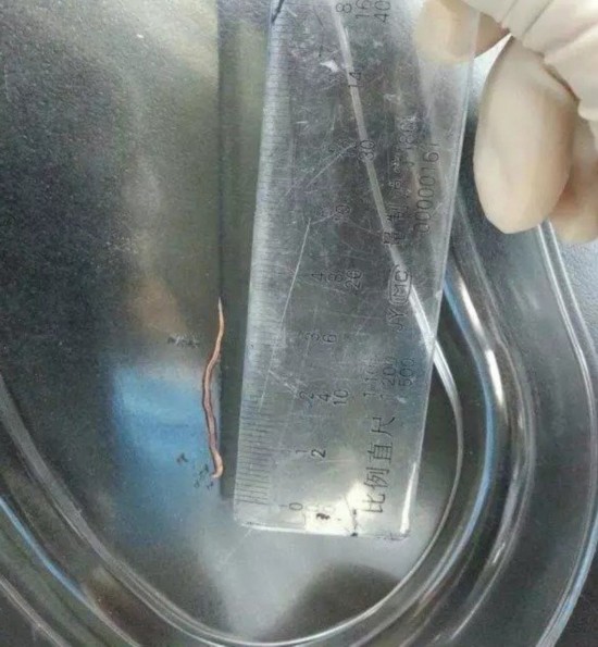 嘉兴一女子咳嗽咳出6条活虫 因吃小龙虾