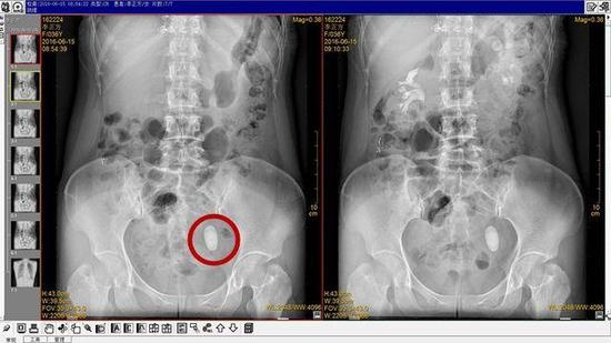 手术前。红圈位置是结石