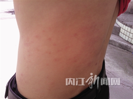 内江威远连界毒蛾扰民 群众浑身发痒红肿