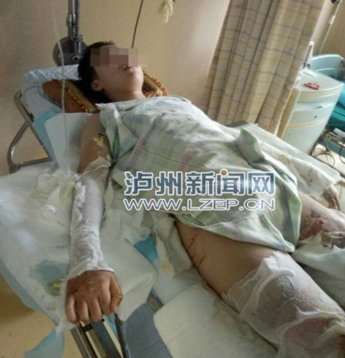 罗永红因烧伤无法随意动弹