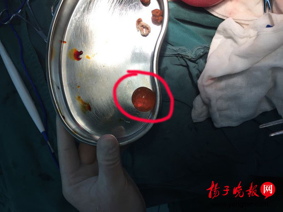 男童误食水宝宝。医生从一岁小军体内取出的已膨胀至乒乓球大小的“水宝宝”玩具。 图由医院提供。