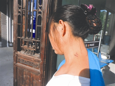 被猴子咬伤的群众