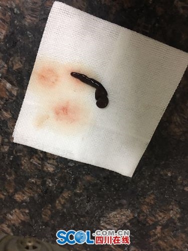 完整取出的长达5cm的蚂蝗