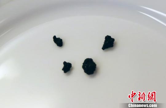 从小明体内取出的胆红素结石。 钟欣 摄