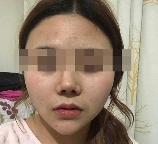 胡女士手術(shù)后的照片
