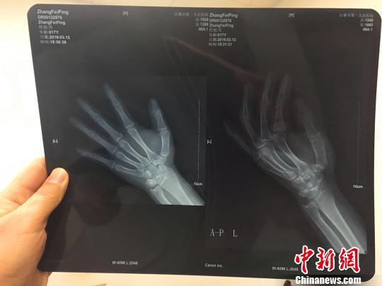 犯罪嫌疑人張某的左手小指折斷 宜都警方 供圖
