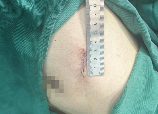 肺结节胸腔镜手术胸壁切口长约3cm